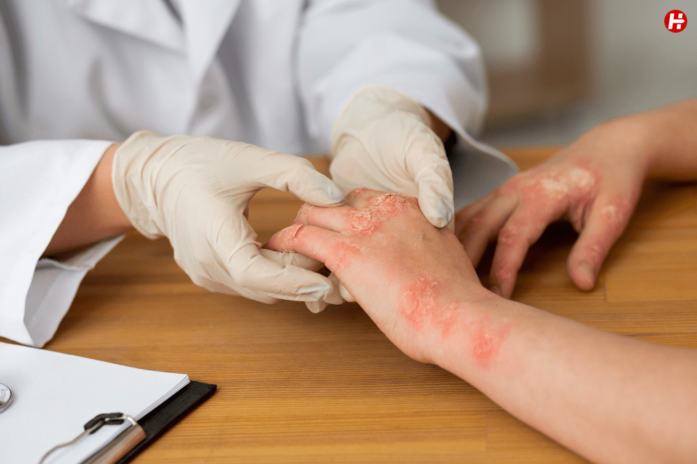 Atopic Eczema Treatment Guidelines